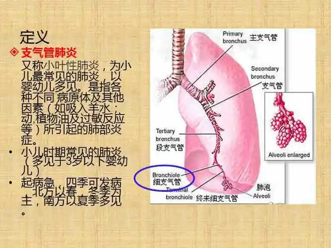 小儿支气管肺炎