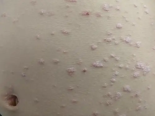 点滴型银屑病——唯一能治愈的牛皮癣