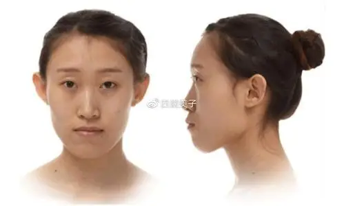 情况三:下巴前翘上颚骨内陷