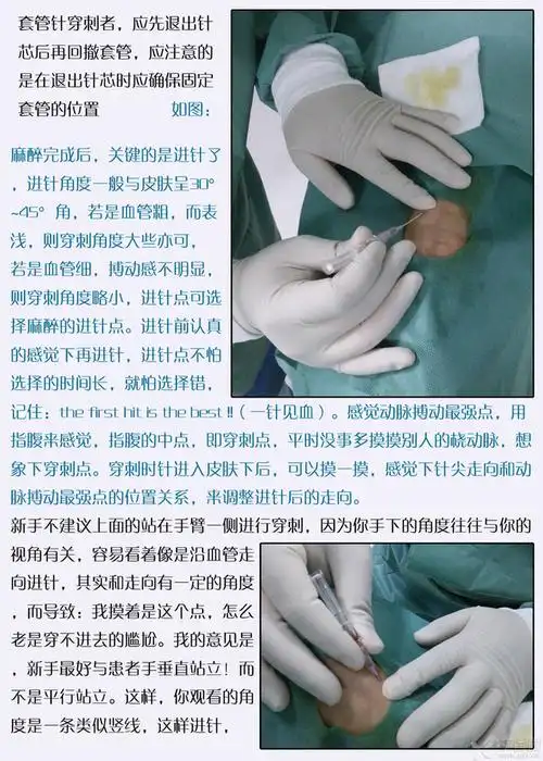 切记:穿刺时,穿刺针斜面向上!局部并发症及处理1.