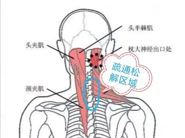 颈椎病之头夹肌损伤引起的症状