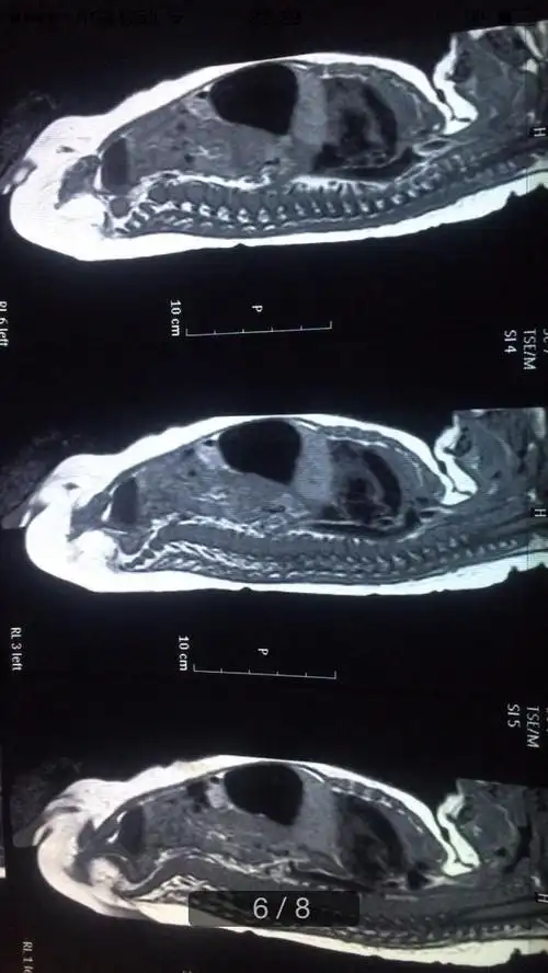 跪求助宝宝四个月脊髓中央管轻度扩张意味着什么