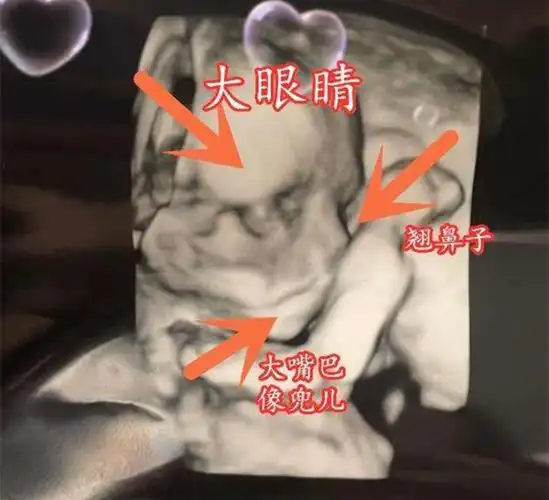 四维彩超如何看男女四维正面鼻大嘴大是男孩女孩