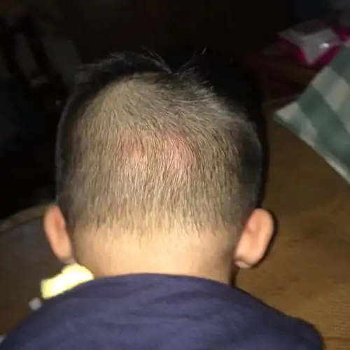 背部毛周角化毛囊炎图片_有来医生