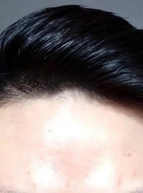 发际线一小块没头发,求解