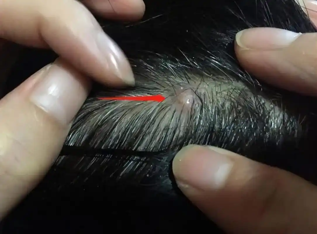 头皮经常长痘是怎么回事?别用手抠,多半是这3个原因造成的