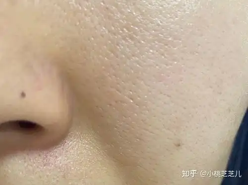 如何决脸上的毛孔粗大黑头太多的问题