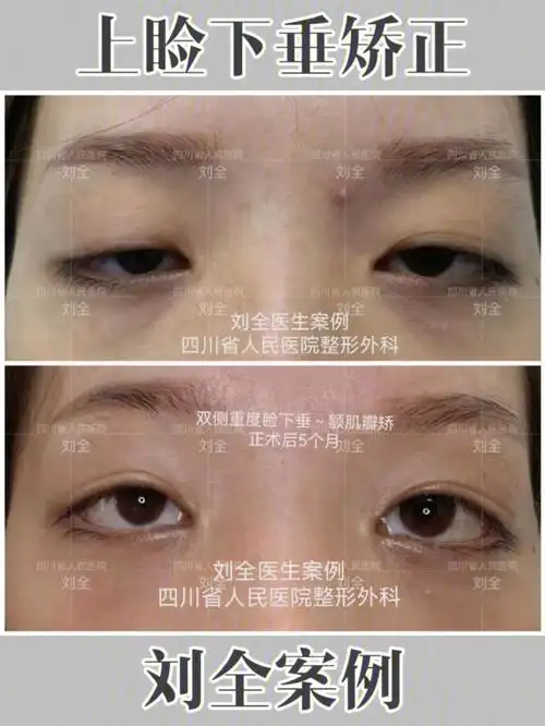 眼睑接近瞳孔中央93|手术总结眼睑上提显著 睁眼自然#上睑下垂  #上