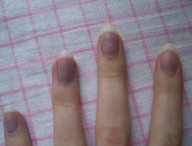 青紫指甲,提示供血不足缺氧,动脉硬化,血脂高(胆固醇高