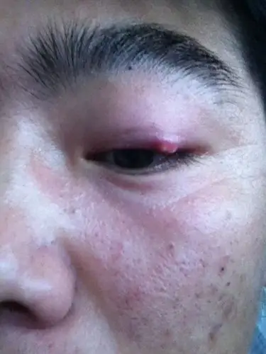 我上眼皮上长疙瘩了,半个月了