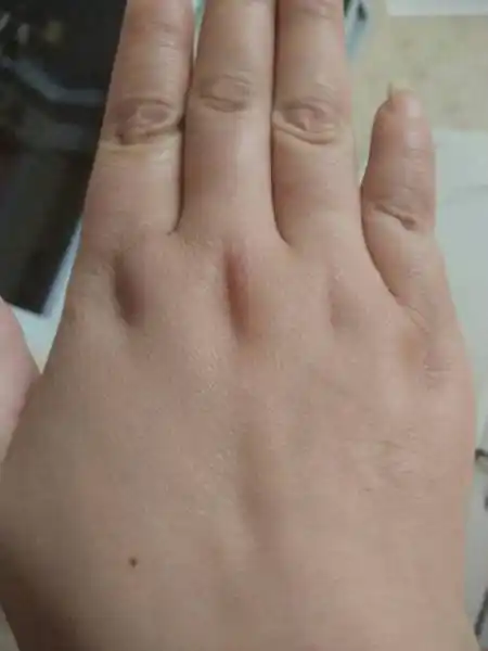 手背痣运势(手背痣的位置和命运)