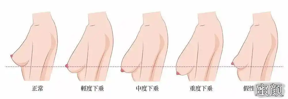 如果我的乳房下垂了,我应该怎么办?手术是唯一能拯救我的方法吗?