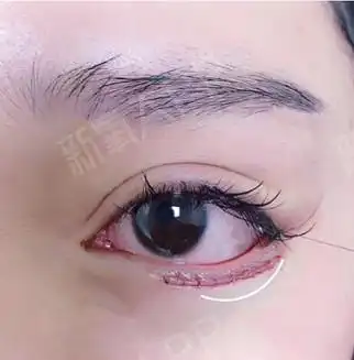下睑下至术前术后对比眼睛增加了不少增添柔和的美感