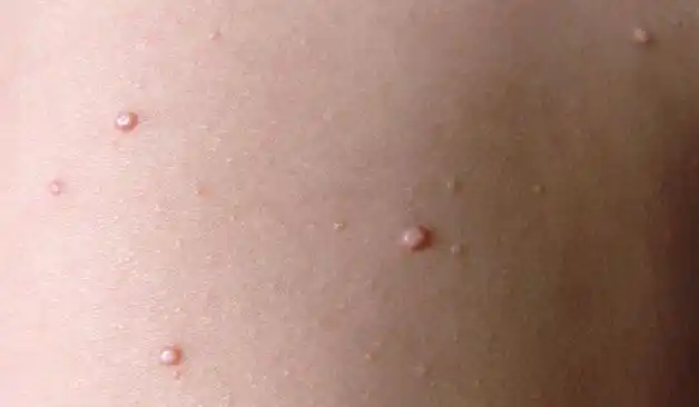 初期小疣体图片