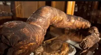 世界上首位被屎憋死的人,肠子重达45斤