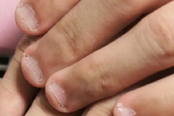 等到孩子把指甲咬到感染变形,才后悔就晚了!