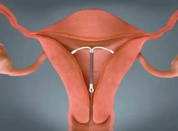 避孕环对女性有伤害吗 比上环更好的避孕方法