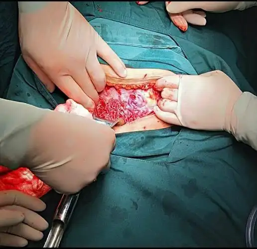 胎盘植入看一眼就被震撼了