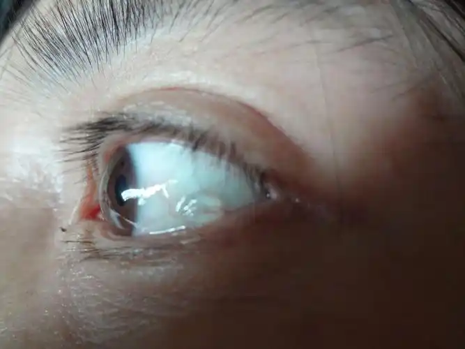 眼球白色上长了一个水泡不疼不痒,没有异