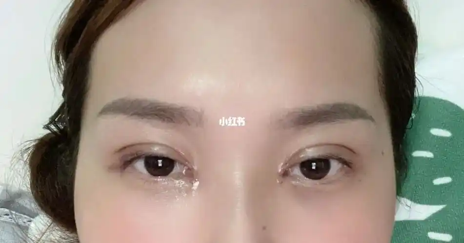 埋线双眼皮77开眼角,第3天,焦虑焦虑_焦虑_开眼角_埋线双眼皮_美妆