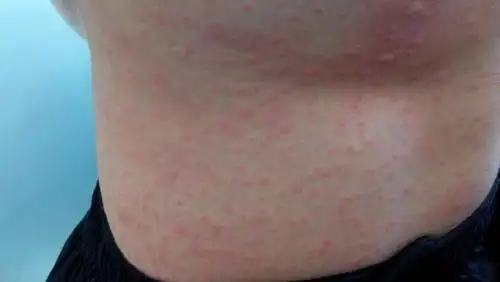 问:今天早上全身皮肤特别痒,抓了变成这样子怎么回事?怎么办?