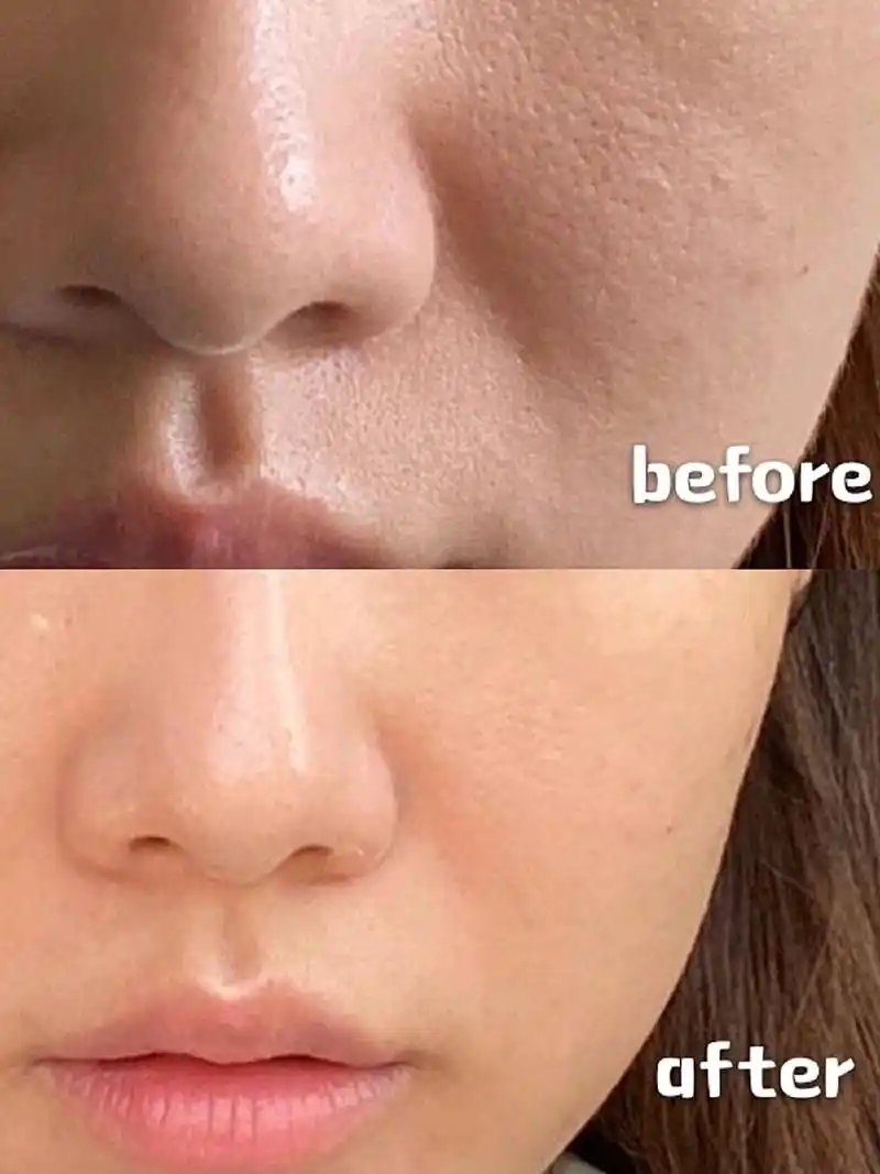 体验前变美诉求:我经常熬夜导致皮肤毛孔粗大,脸颊处干纹变细纹,皮肤