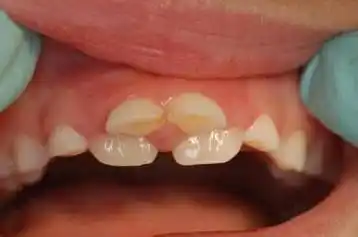 医生,我家宝贝长了两排牙齿,这到底是怎么回事?_手机搜狐网