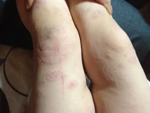 湿疹复发有好办法