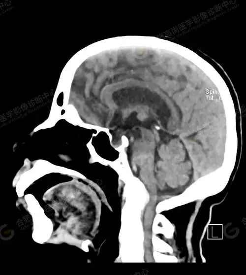 【高尚病例】术前检查头颅ct平扫发现"颅底凹陷症"1例_测量_枕骨_显示