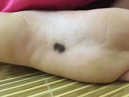 脚底突然起了一块黑斑,周围还有3个小点,不凸起不痛不痒什么症状都没