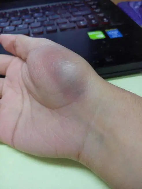 当时以为是污渍,后来洗手洗不掉,这是怎么了,手金星丘这里发乌,跟摔青