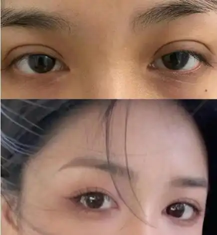 假宽深,肉条感双眼皮是门诊中遇到的最多,也最常见的双眼皮修复类型.