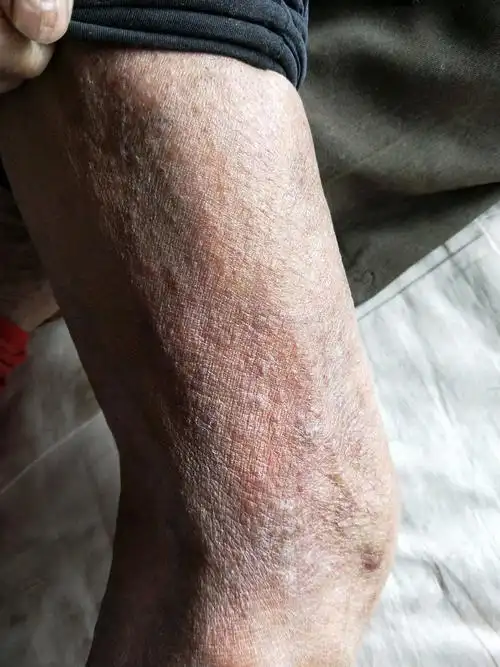 湿疹的辨证论治 湿热型 证见皮肤可见红斑肿胀丘疹水疱脓疱糜烂,渗液