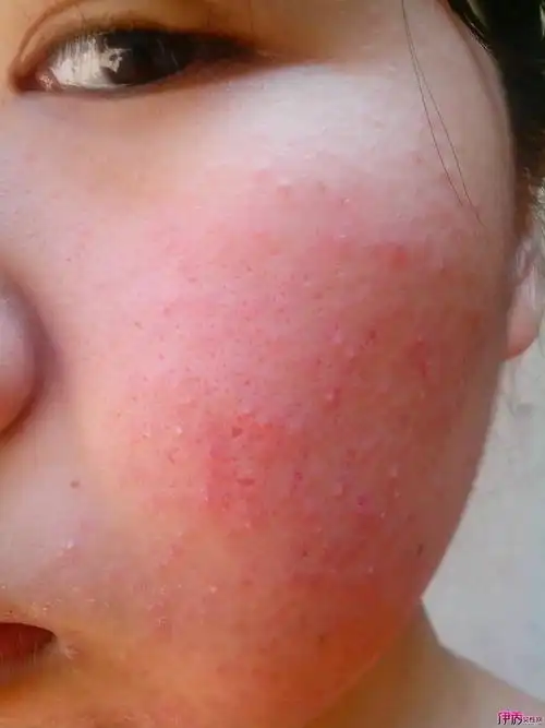 皮肤过敏发红怎么办(过敏了发红怎么办)_奇闻趣事_qq猎鹰乐园