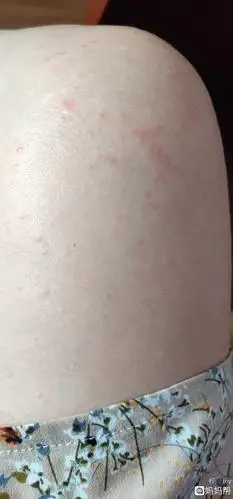 孕晚期湿疹经历,希望可以帮到需要的姐妹们.