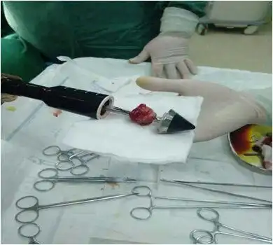 直肠粘膜环切术