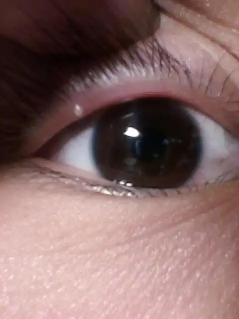 上眼皮紧里面长了个白点 眨眼就疼 有图 这怎么回事帮帮忙阿