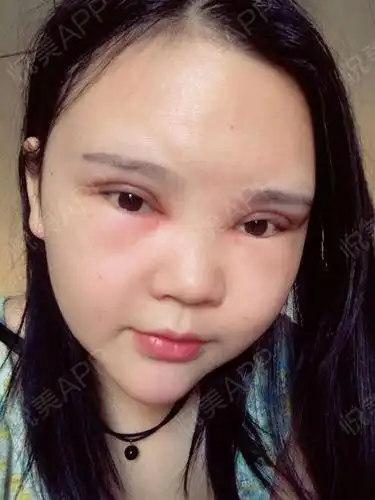 自体脂肪面部填充术后10天_面部填充术后10天_开眼角术后10天_自体