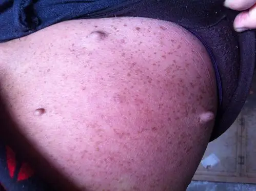 有位亲的身上起了这种疙瘩似的小瘤子,谁能知道这是