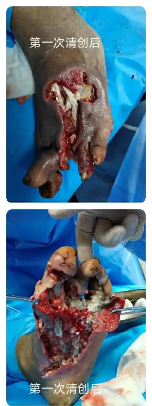 第一次清创后
