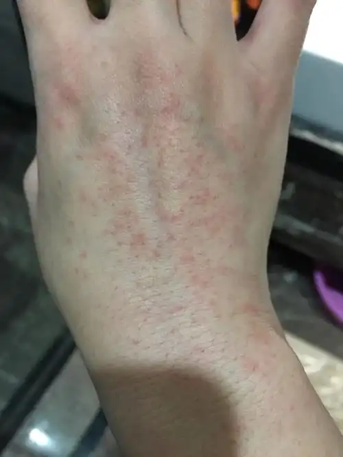 医护人员这双手红疹粒粒满艰辛