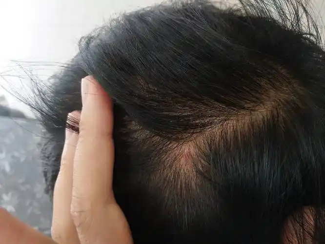 头皮上有红色的疙瘩是怎么回事