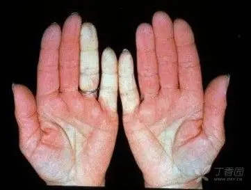 【毒门秘籍】"肉毒毒素差异化"系列专题 - 皮肤与性传播疾病讨论