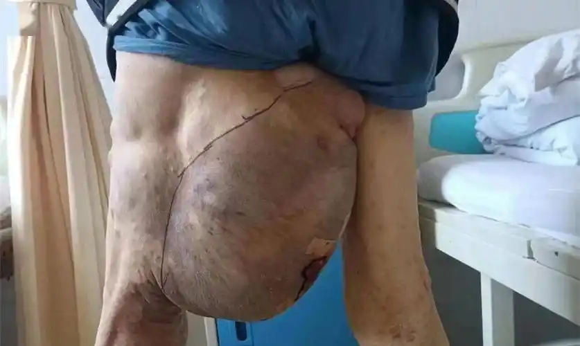 庄浪成功开展一例大腿巨大复发肿瘤切除术