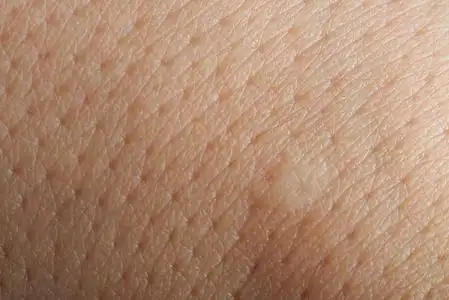 皮肤毛孔粗大图片