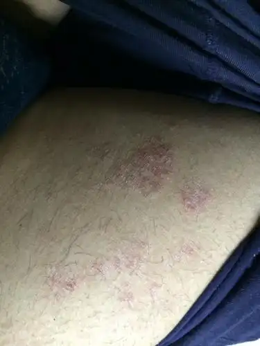 我的大腿上面起了一大片红色的不知道什么的