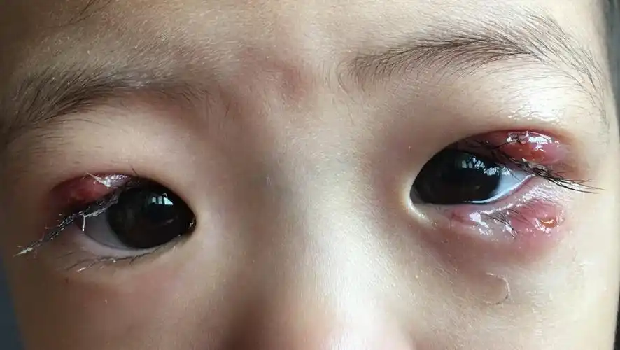 那些被家长耽误的霰粒肿