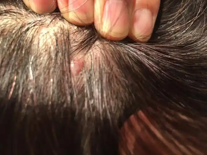 我头上长了一个疙瘩越挠越痒不知道怎么回事