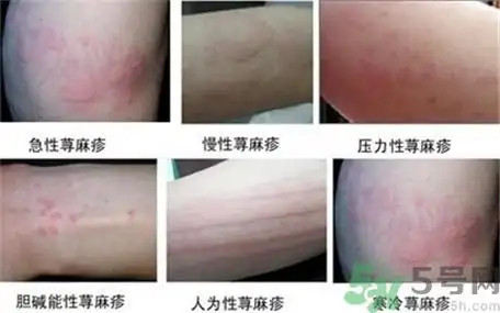 数分钟在暴露部位出现荨麻疹,1小时内消失,较少见,风团发生于暴露皮肤