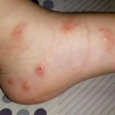 急急急,宝宝身上长了好多小包包,还会变成水泡怎麼办?